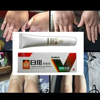 30g Kinų Medicinos Balta Dėmė Ligos Kremas Pigmento Vitiligo Leukoplakia Ligos Gydymas Melanino Skatinti Liniment Odos