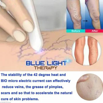 1Pcs Nešiojamų Mėlynos Šviesos Terapija Lazerio Spuogų Pen Odos Dėmes Pen Stabdžių Venų Voras Veną Trintukas Gydymas