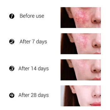 Anti-acne kremas, valymo kremas blackhead spuogų kremas repair oil control gel sutraukti poras randų veido priežiūrai, balina odą, 30g