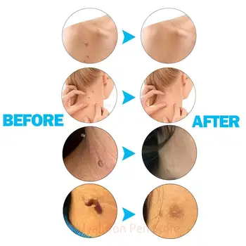 Mikro odos žymeklį nuėmiklių Rinkinys quita verrugas veido mole, Karpų šalinimas, Micro Juosta odos žymę, išimkite pleistrą Mažoms ir Vidutinėms odos tegus
